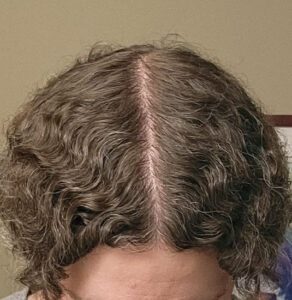 Memphis hair doctor patient after hair transplant tilt view