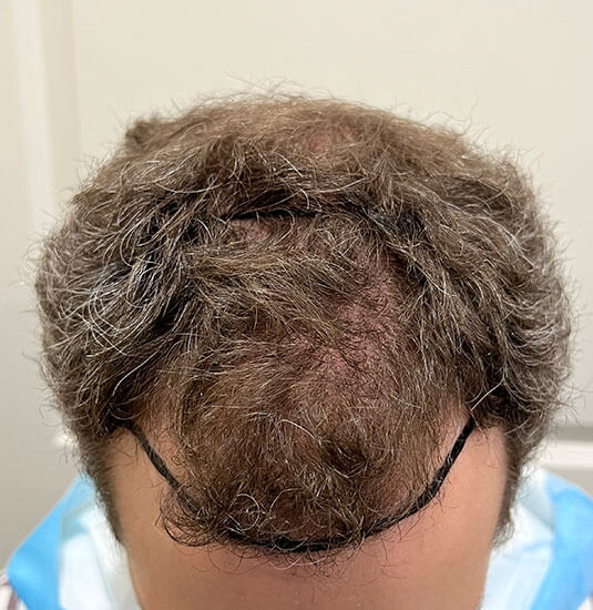 Memphis hair doctor patient before hair transplant tilt view