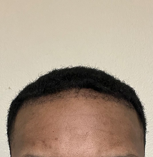 Memphis hair doctor patient 3 month post-op hair transplant front view