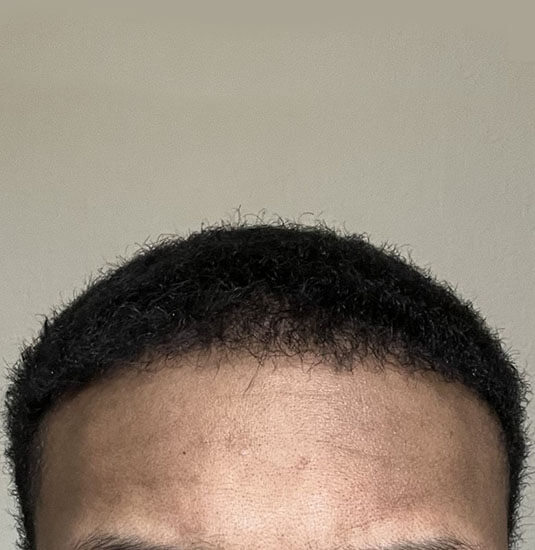 Memphis hair doctor patient 6 month post-op hair transplant front view