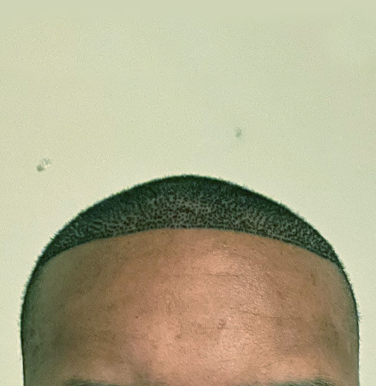 Memphis hair doctor patient 7 day post-op hair transplant front view