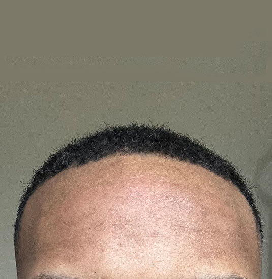 Memphis hair doctor patient before hair transplant front view