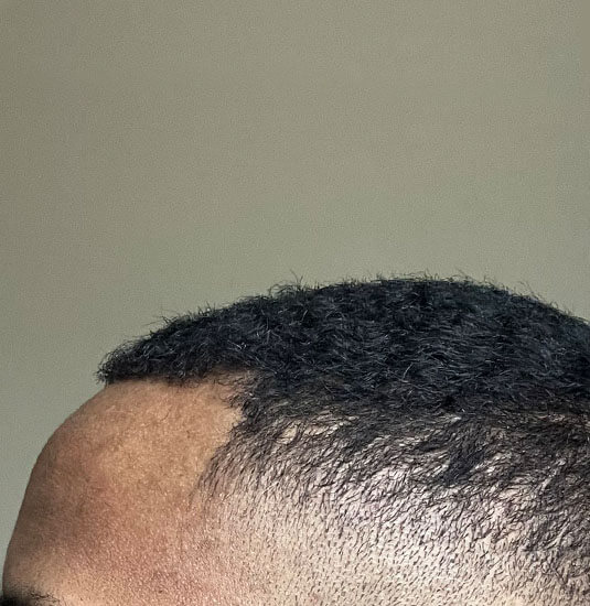 Memphis hair doctor patient before hair transplant side view