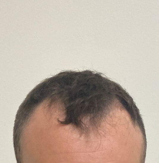 Nashville hair doctor patient before hair transplant front view
