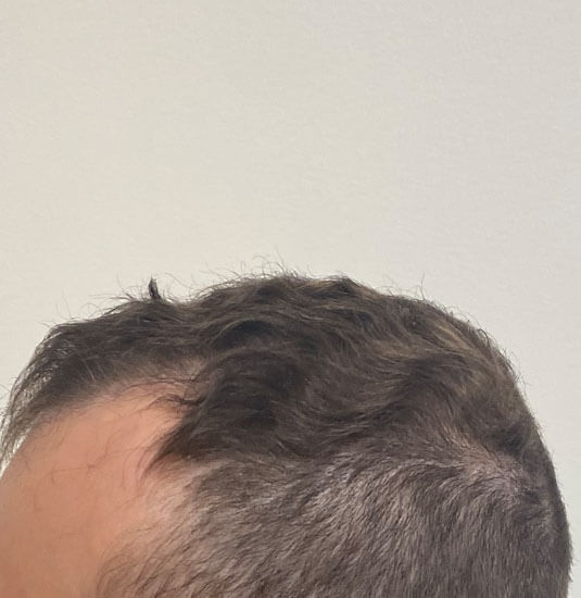 Nashville hair doctor patient before hair transplant side view