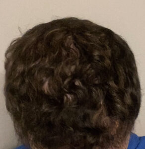 Nashville hair doctor patient after hair transplant top view