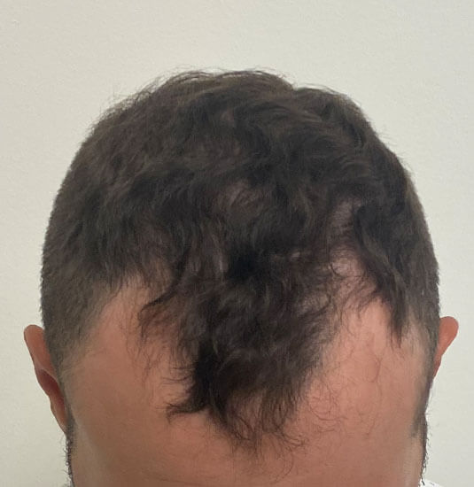 Nashville hair doctor patient before hair transplant top view