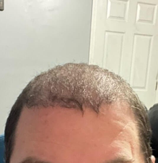 Nashville hair doctor patient after hair transplant front view