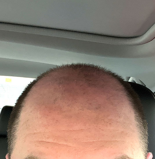 Nashville hair doctor patient before hair transplant front view