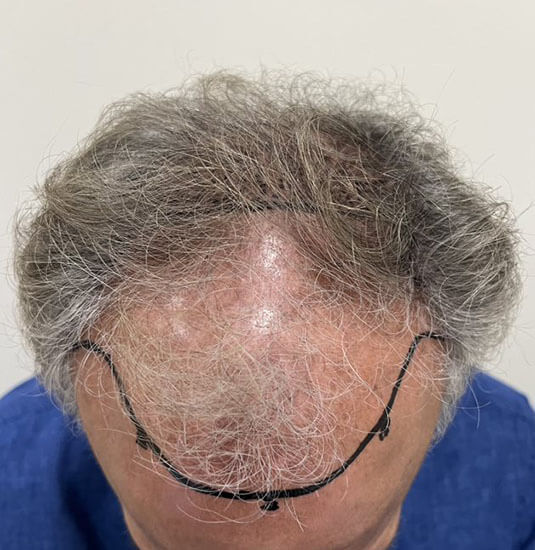 Nashville hair doctor patient before hair transplant tilt view