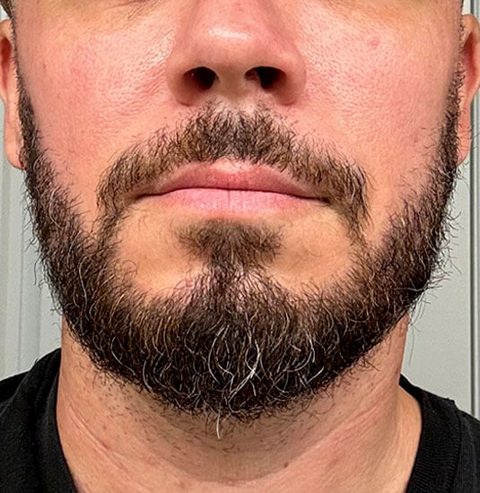Nashville Hair Doctor beard transplant patient halfway results at 6 months - front view