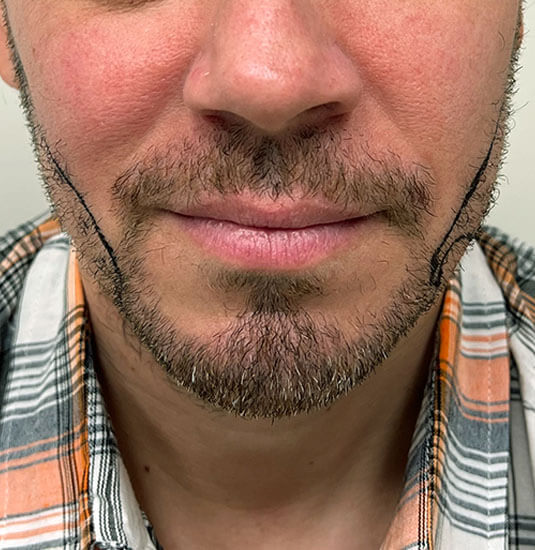 Nashville Hair Doctor beard transplant patient before procedure - front view