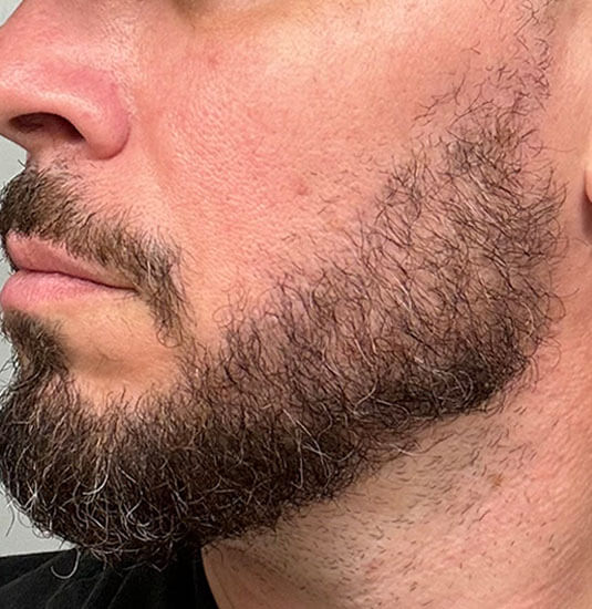 Nashville Hair Doctor beard transplant patient halfway results at 6 months - left side view
