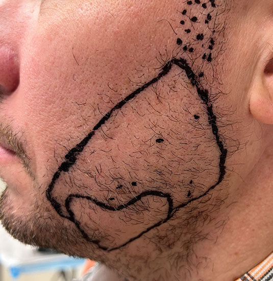 Nashville Hair Doctor beard transplant patient before procedure - left side view