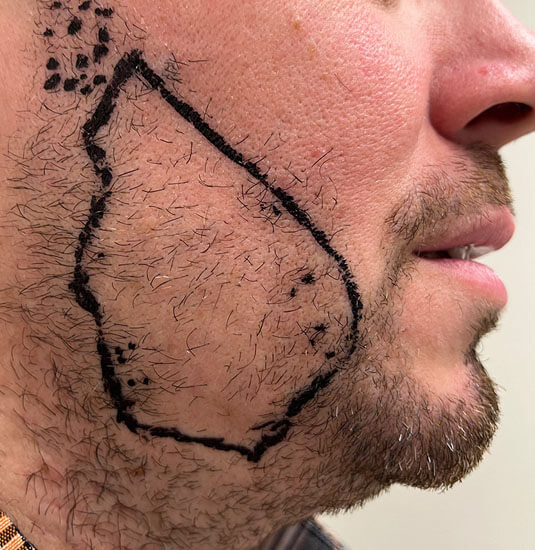 Nashville Hair Doctor beard transplant patient before procedure - right side view