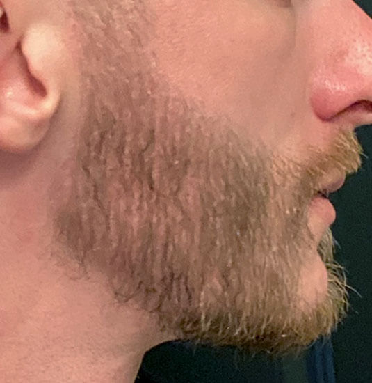 Nashville Hair Doctor beard transplant patient halfway results at 6 months - right side view
