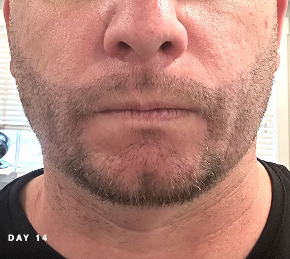 nashville hair doctor beard transplant recovery day 14 front view