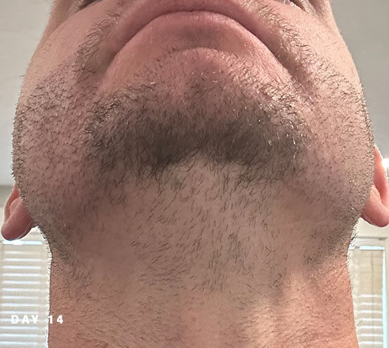 nashville hair doctor beard transplant recovery day 14 tilt view