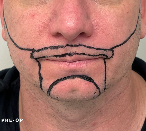 nashville hair doctor beard transplant recovery pre-op front view