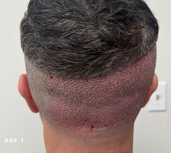 hair transplant recovery of donor hair on day 1