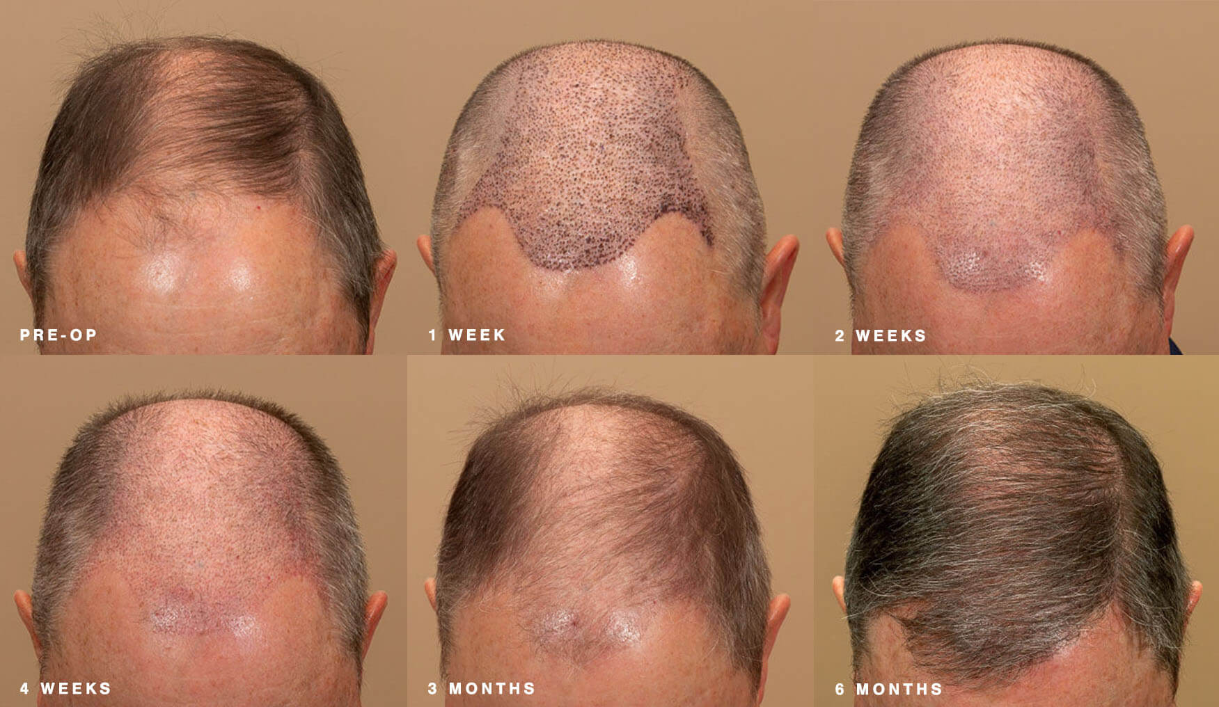 nashville hair doctor growth cycles from pre-op to 6 months in 6 stages, top view