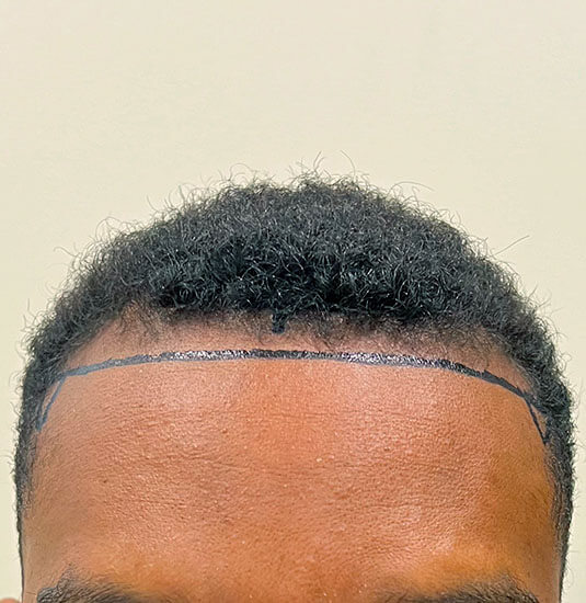 Nashville hair doctor patient before hair transplant front view