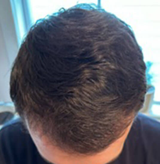 Nashville hair doctor patient after hair transplant top view