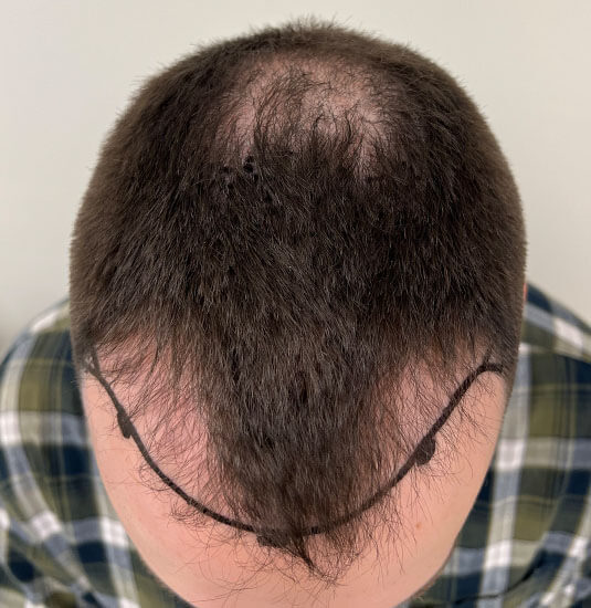 Nashville hair doctor patient before hair transplant top view