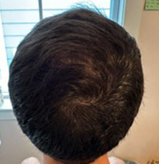 Nashville hair doctor patient after hair transplant tilt view