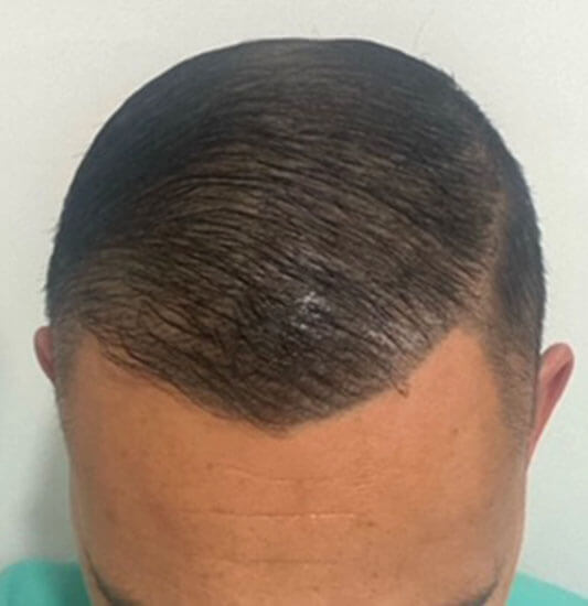 Nashville hair doctor patient 13 months after hair transplant front view