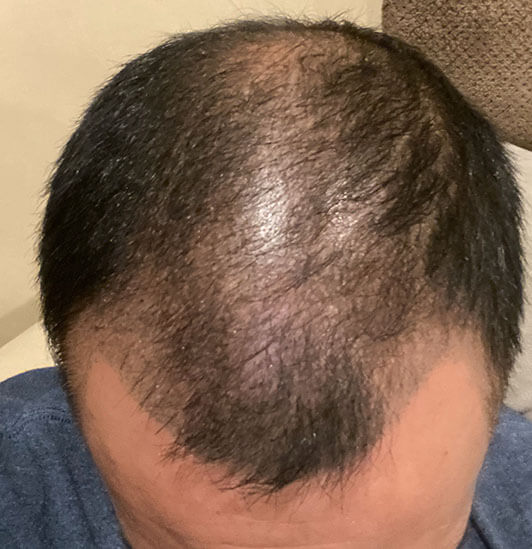 Nashville hair doctor patient before hair transplant top view