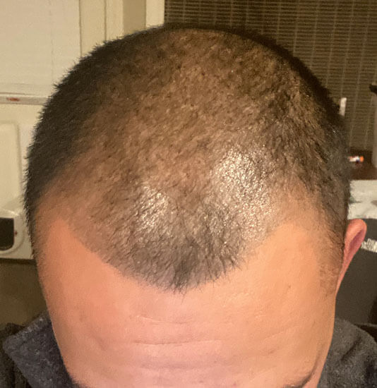 Nashville hair doctor patient before hair transplant front view