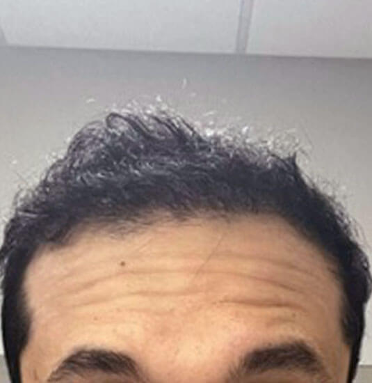 Nashville hair doctor patient 6 months after hair transplant front view