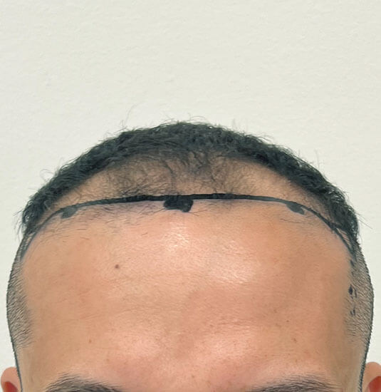 Nashville hair doctor patient before hair transplant front view