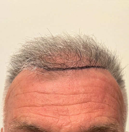 Nashville hair doctor patient before hair transplant front view.