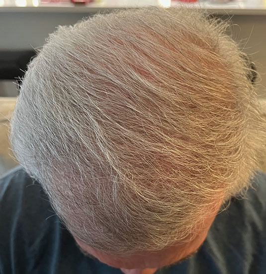 Nashville hair doctor patient 6 months after hair transplant top view.