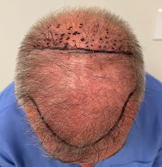 Nashville hair doctor patient before hair transplant top view.