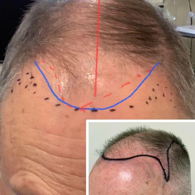 nashville hair doctor patient John before his neograft procedure