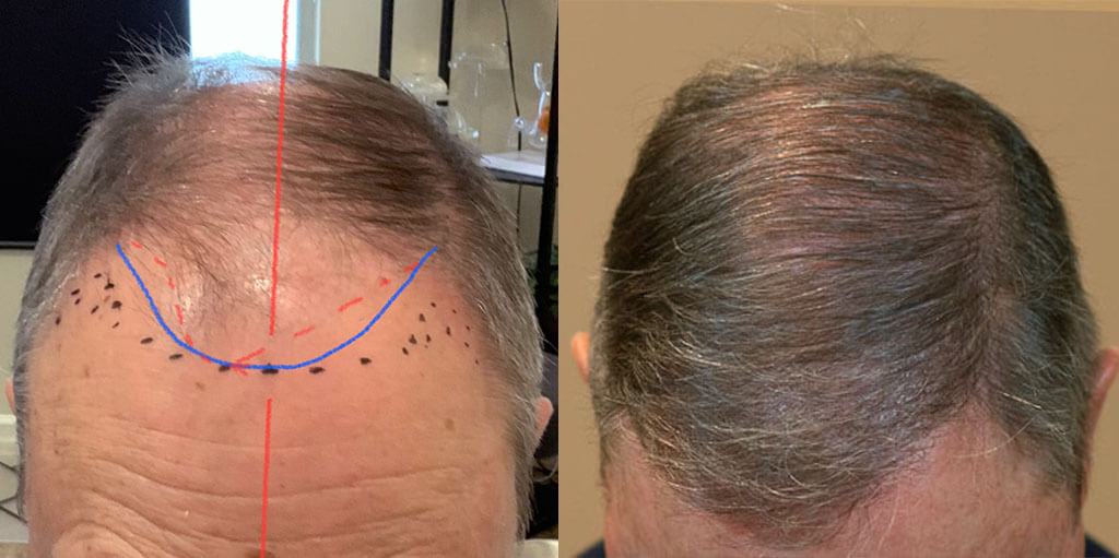 memphis hair doctor patient John before and 12 months after his hair transplant of 2500 grafts