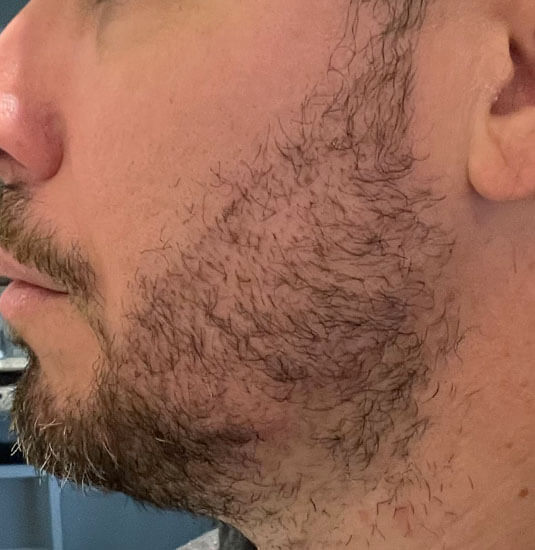 nashville hair doctor patient 2 weeks after beard transplant procedure - left side