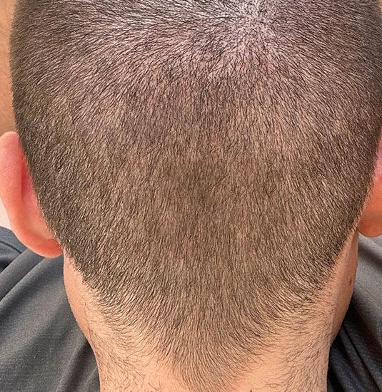 nashville hair doctor patient 2 weeks after hair transplant - donor area