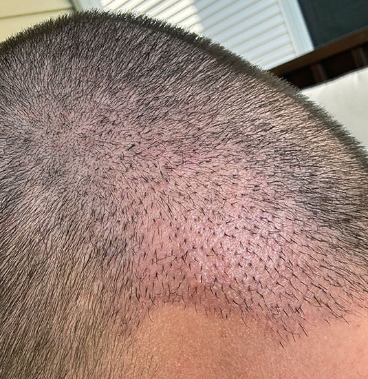 nashville hair doctor patient 2 weeks after hair transplant - right side