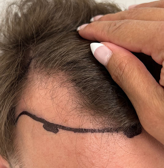 nashville hair doctor patient before hair transplant - right side