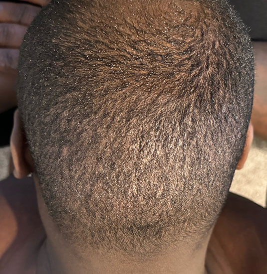 nashville hair doctor patient 2 weeks after hair transplant - donor area