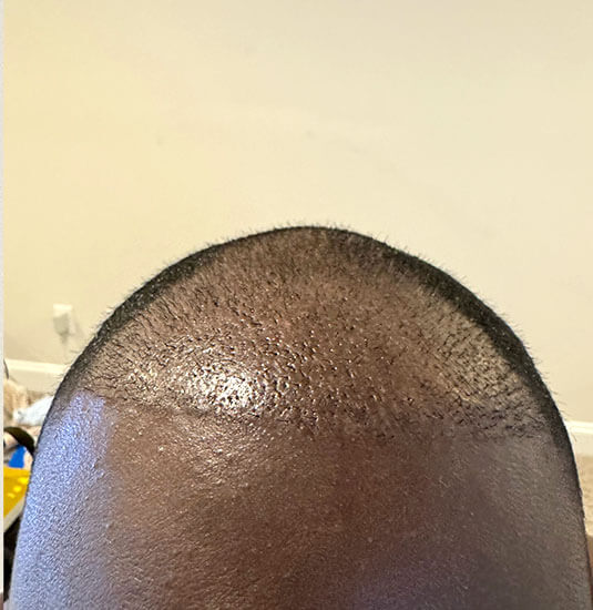 nashville hair doctor patient 2 weeks after hair transplant - front view