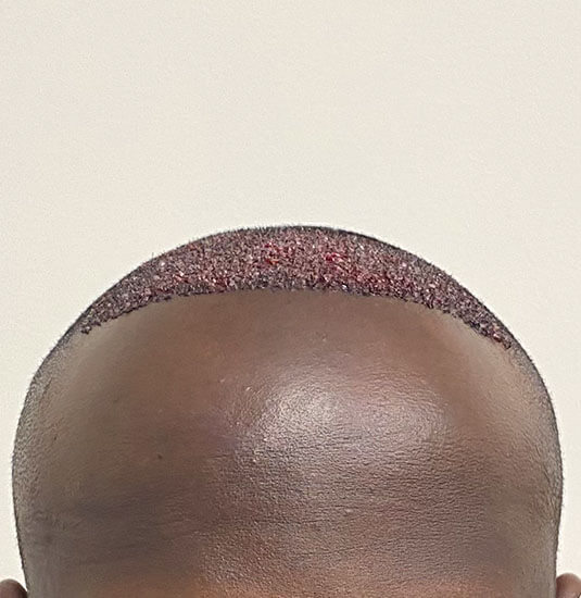 nashville hair doctor patient right after hair transplant - front view