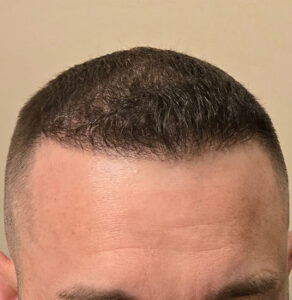 Nashville hair doctor patient 8mo after hair transplant front view.