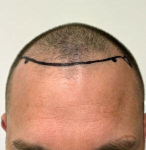 Nashville hair doctor patient before hair transplant front view.