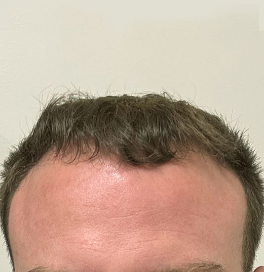 Nashville hair doctor patient 6 months after hair transplant - front view.