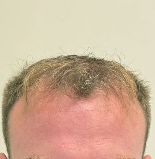 Nashville hair doctor patient before hair transplant - front view.